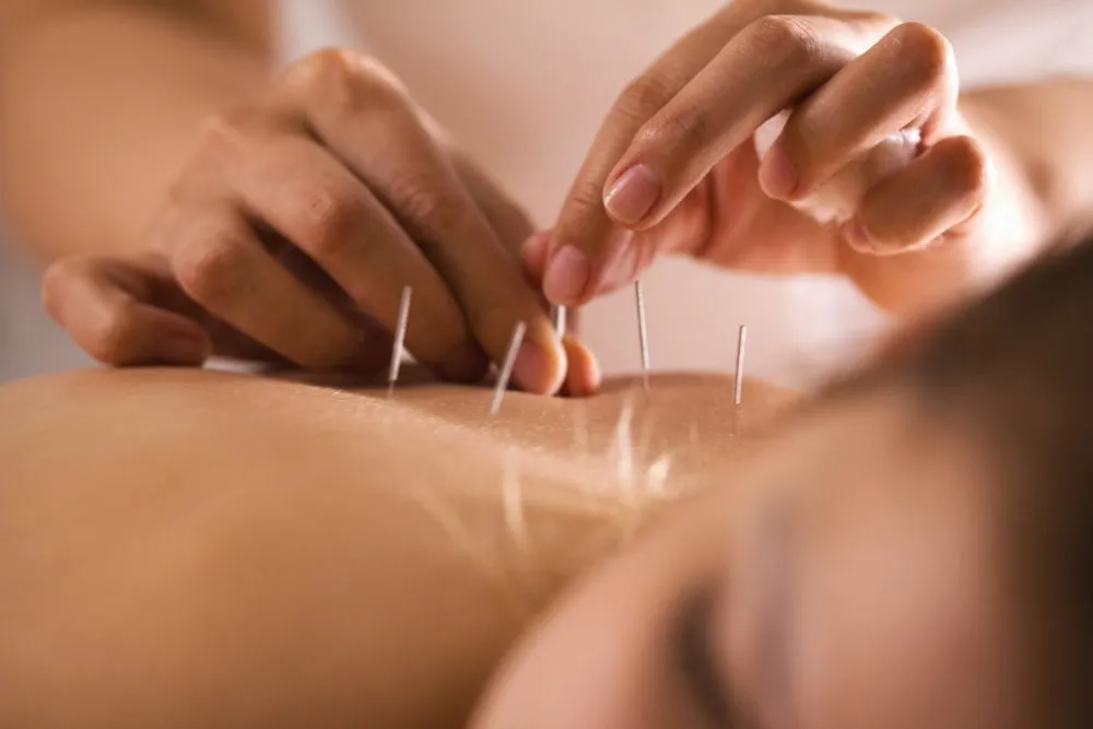 Traditional acupuncturist inserting needles into patient's back.
